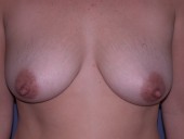 breast_augmentation-1