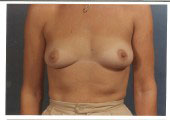 breast_augmentation-4