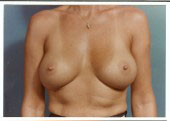 breast_augmentation-4