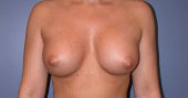 breast_augmentation-4