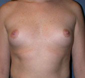 breast_augmentation-4