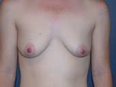 breast_augmentation-4