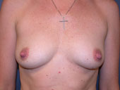 breast_augmentation-4