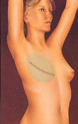 breast_reconstruction-1