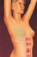 breast_reconstruction-6