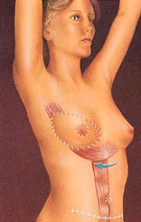 breast_reconstruction-7