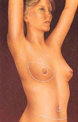 breast_reconstruction-8