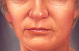 facial_implant-2