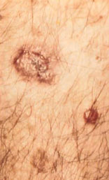 skin_cancer-2