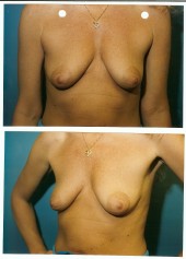 breast_lift-1