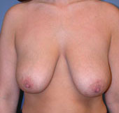 breast_lift-1