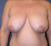 breast_lift-1