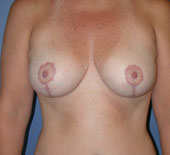 breast_lift-2