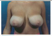 breast_reduction-1