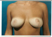 breast_reduction-2