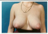 breast_reduction-3