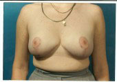 breast_reduction-4