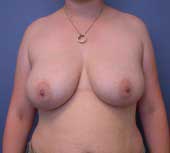 breast_reduction-4