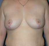 breast_reduction-4